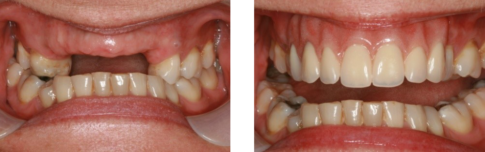  dental bridge front teeth nhs